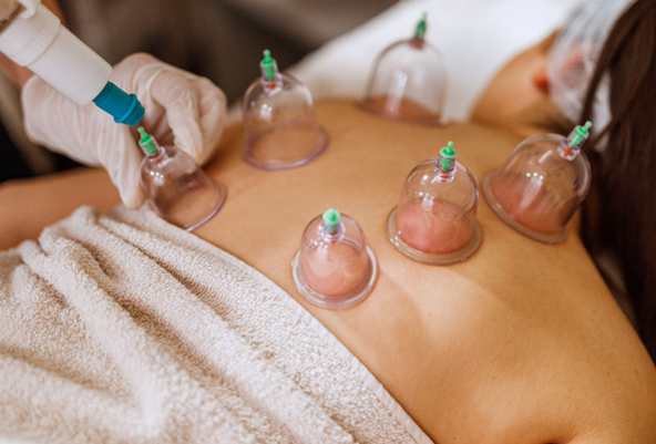 Cupping Therapy 